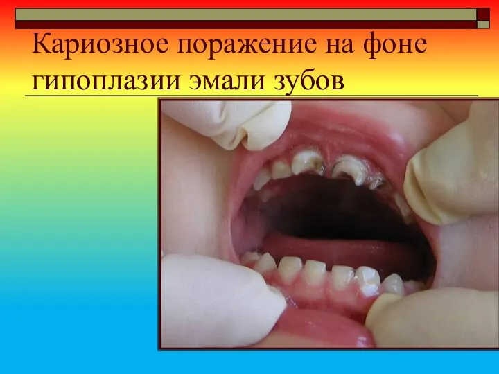 Кариозное поражение на фоне гипоплазии эмали зубов