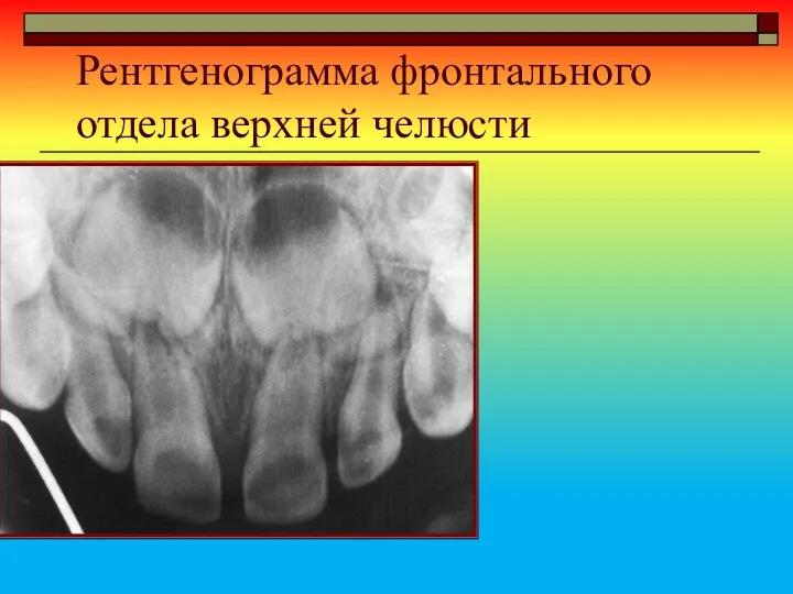 Рентгенограмма фронтального отдела верхней челюсти