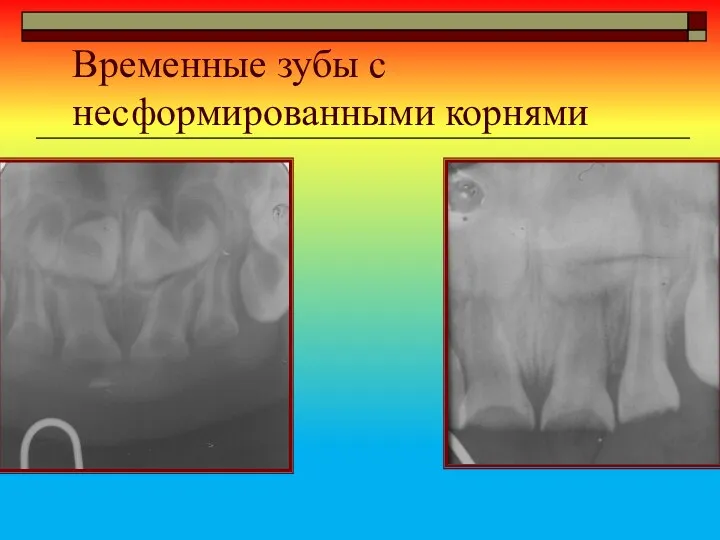 Временные зубы с несформированными корнями