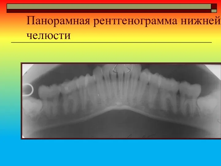 Панорамная рентгенограмма нижней челюсти