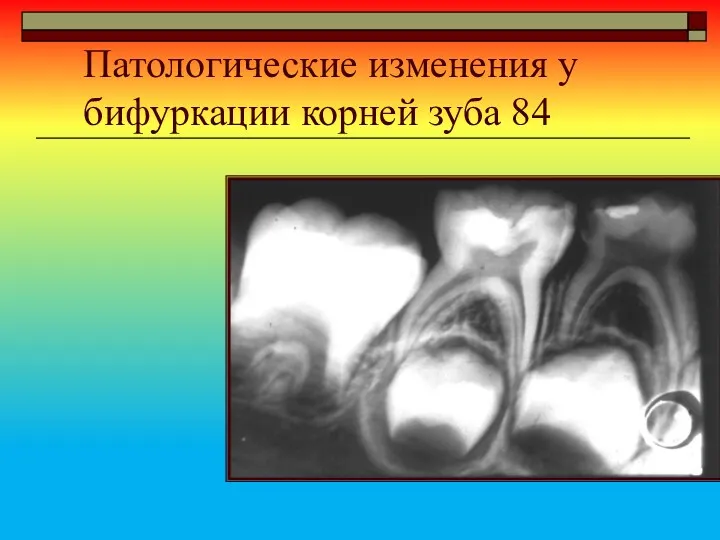 Патологические изменения у бифуркации корней зуба 84