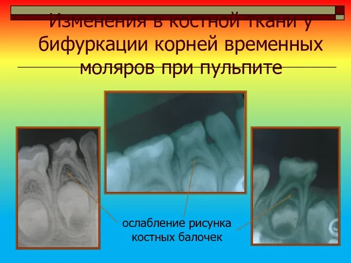 Изменения в костной ткани у бифуркации корней временных моляров при пульпите ослабление рисунка костных балочек