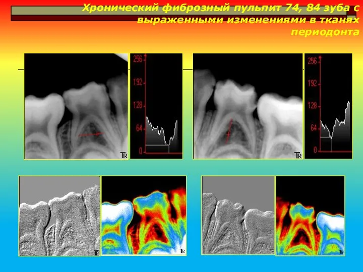 Хронический фиброзный пульпит 74, 84 зуба с выраженными изменениями в тканях периодонта
