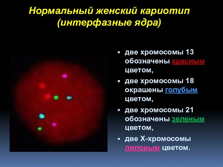 Нормальный женский кариотип (интерфазные ядра) две хромосомы 13 обозначены красным цветом, две хромосомы
