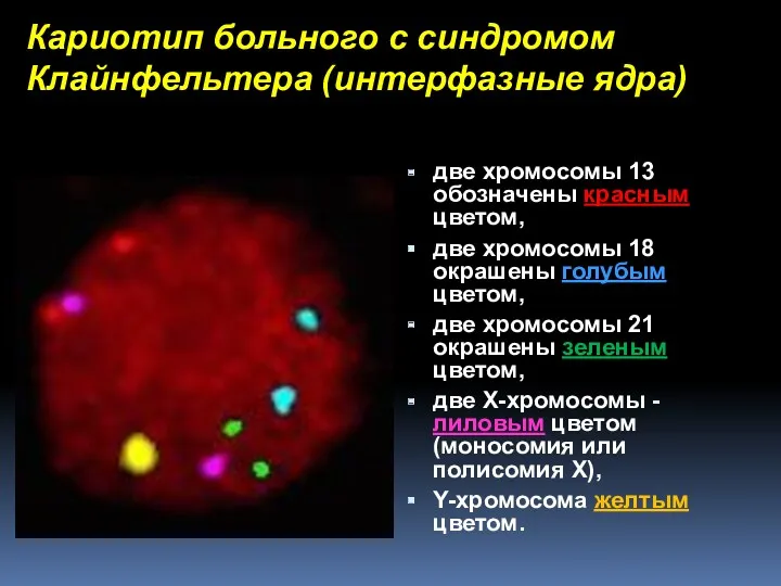 Кариотип больного с синдромом Клайнфельтера (интерфазные ядра) две хромосомы 13 обозначены красным цветом,