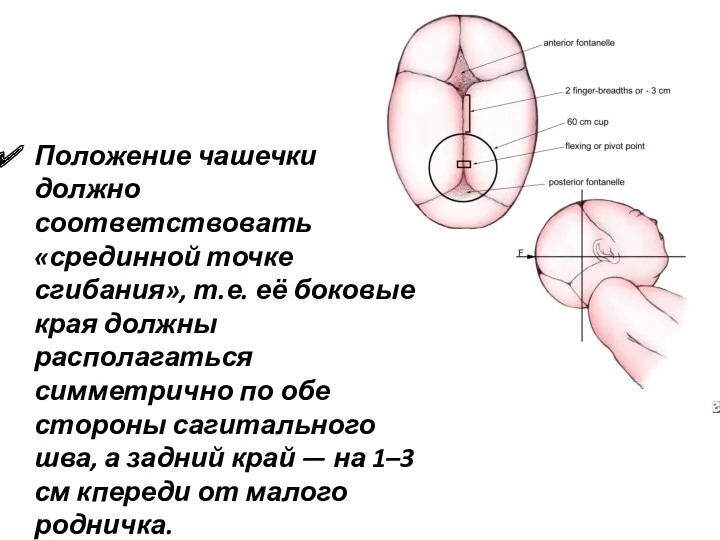 Положение чашечки должно соответствовать «срединной точке сгибания», т.е. её боковые края должны располагаться