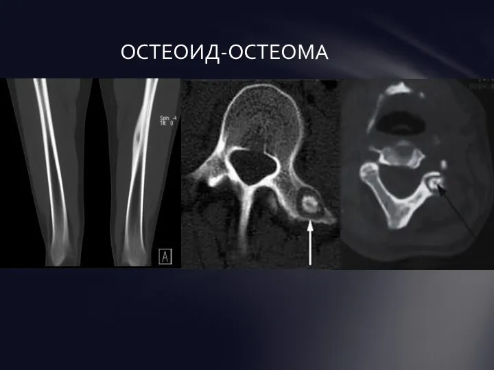 ОСТЕОИД-ОСТЕОМА