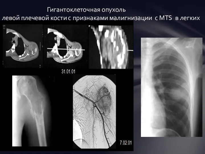 Гигантоклеточная опухоль левой плечевой кости с признаками малигнизации с MTS в легких