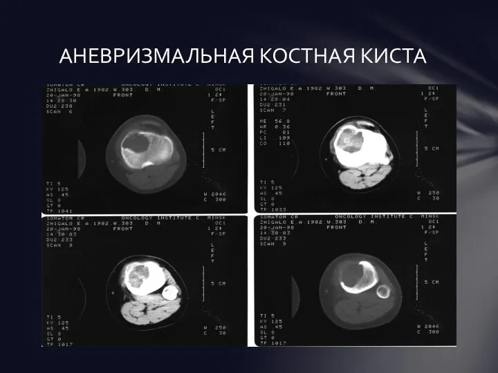 АНЕВРИЗМАЛЬНАЯ КОСТНАЯ КИСТА