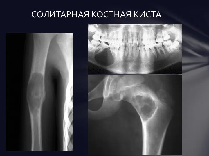 СОЛИТАРНАЯ КОСТНАЯ КИСТА