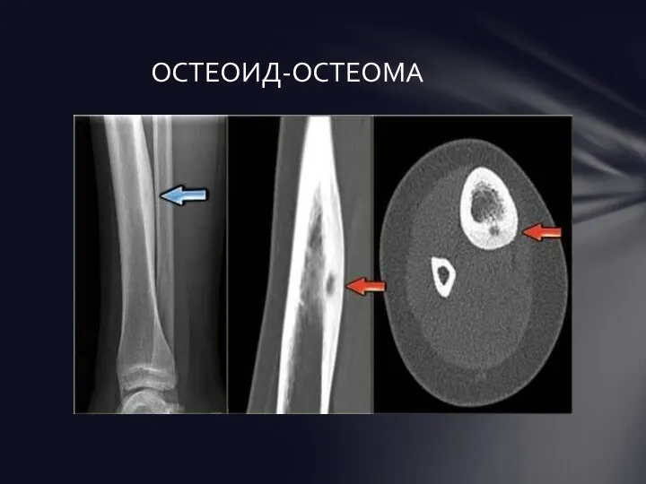 ОСТЕОИД-ОСТЕОМА