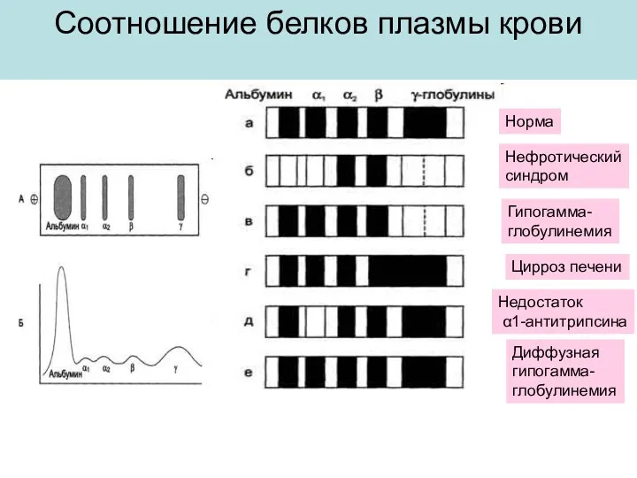 Соотношение белков плазмы крови Норма Нефротический синдром Цирроз печени Гипогамма- глобулинемия Недостаток α1-антитрипсина Диффузная гипогамма- глобулинемия