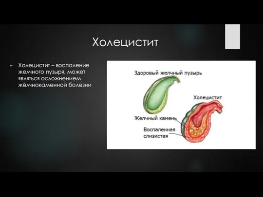 Холецистит Холецистит – воспаление желчного пузыря, может являться осложнением жёлчнокаменной болезни