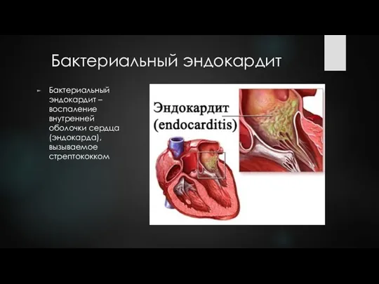 Бактериальный эндокардит Бактериальный эндокардит – воспаление внутренней оболочки сердца (эндокарда), вызываемое стрептококком