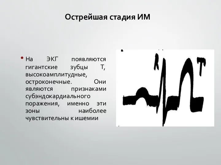 Острейшая стадия ИМ На ЭКГ появляются гигантские зубцы Т, высокоамплитудные,