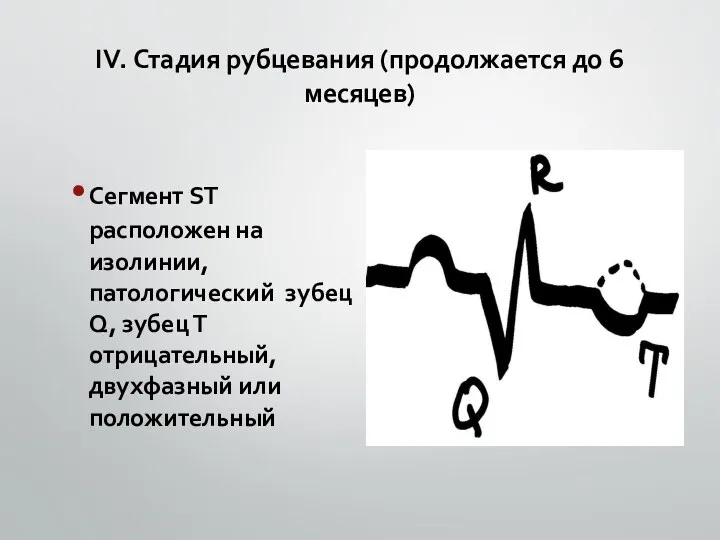 ІV. Стадия рубцевания (продолжается до 6 месяцев) Сегмент ST расположен