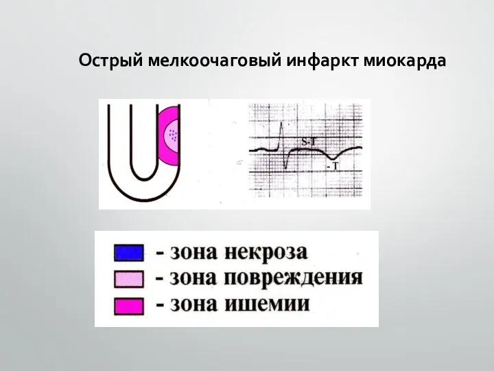 Острый мелкоочаговый инфаркт миокарда