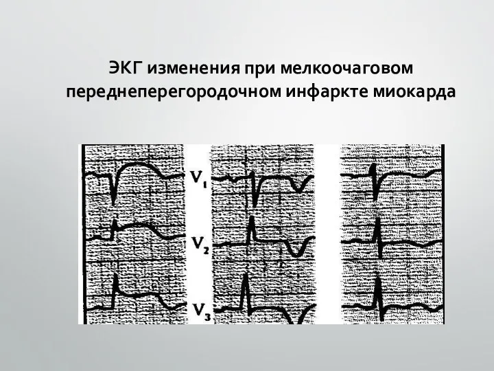 ЭКГ изменения при мелкоочаговом переднеперегородочном инфаркте миокарда