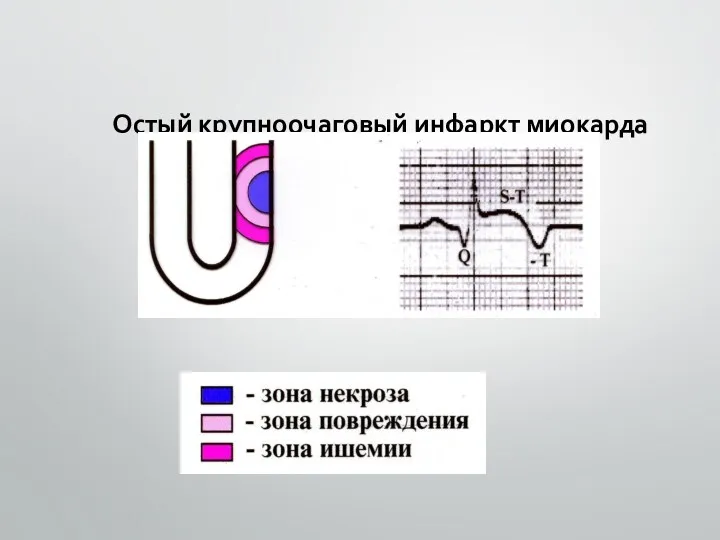 Остый крупноочаговый инфаркт миокарда