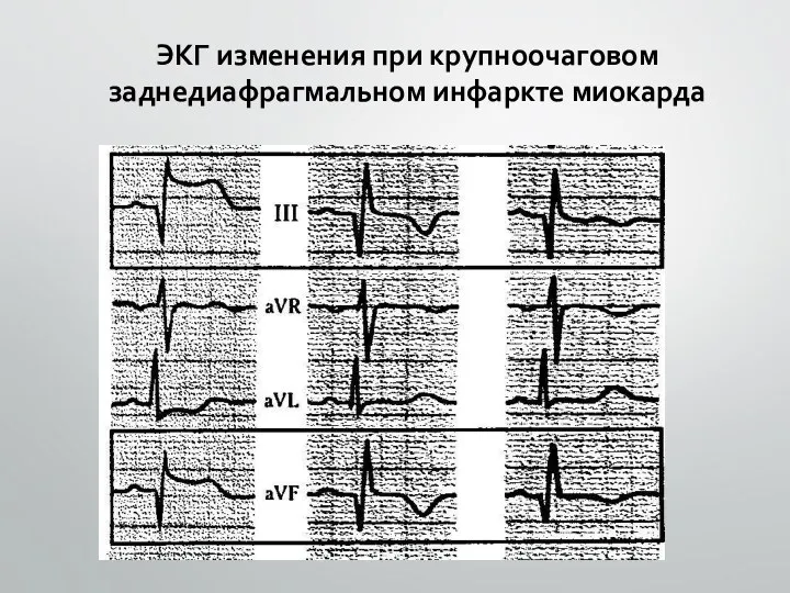 ЭКГ изменения при крупноочаговом заднедиафрагмальном инфаркте миокарда