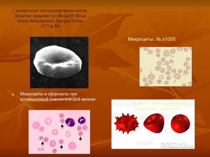 Сканирующая электронная микроскопия. Дискоцит нормоцит (из Bessis M: Blood Smears