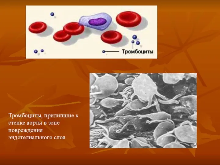 Тромбоциты, прилипшие к стенке аорты в зоне повреждения эндотелиального слоя