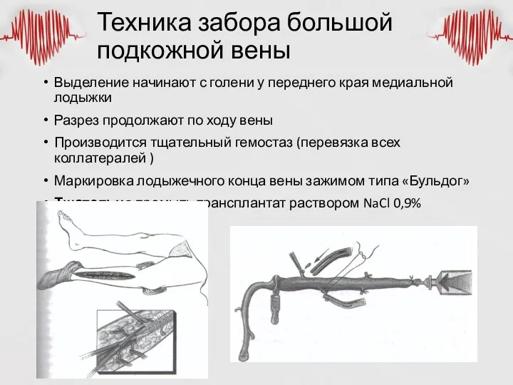 Техника забора большой подкожной вены Выделение начинают с голени у