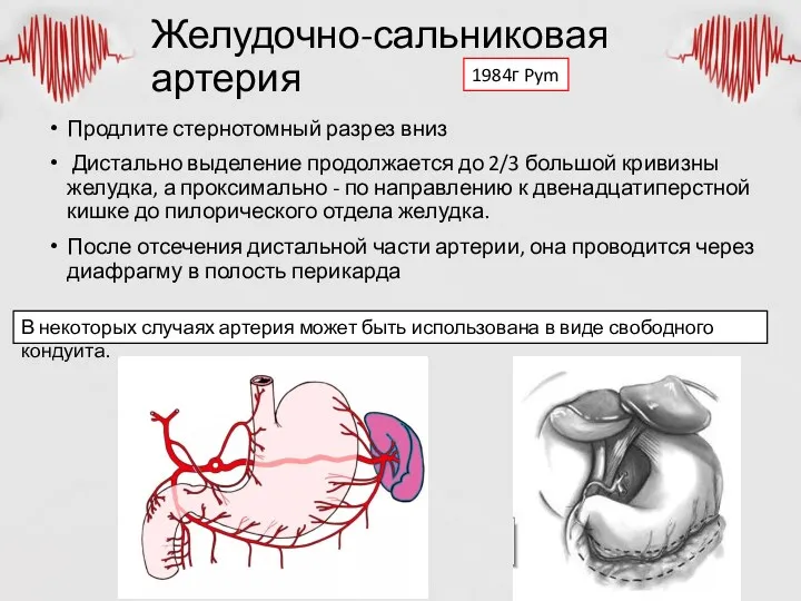 Желудочно-сальниковая артерия Продлите стернотомный разрез вниз Дистально выделение продолжается до