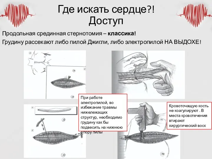 Где искать сердце?! Доступ Продольная срединная стернотомия – классика! Грудину