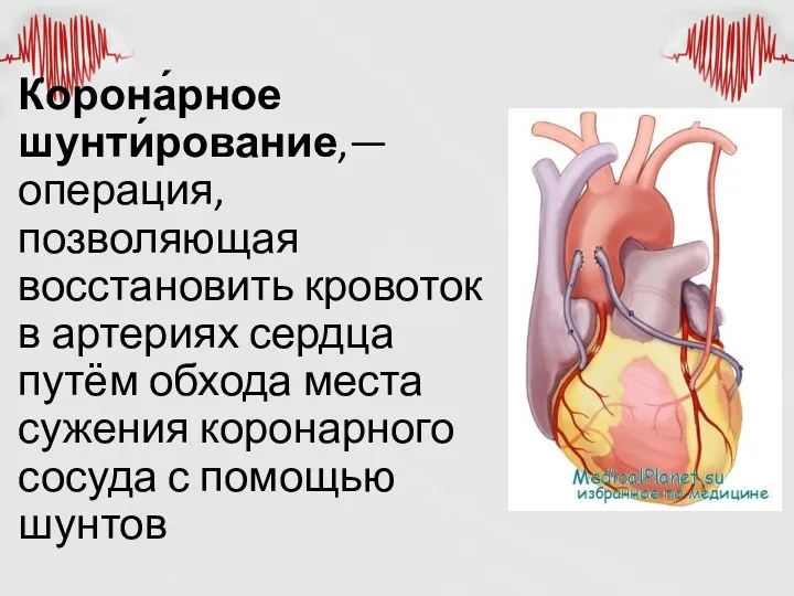 Корона́рное шунти́рование,— операция, позволяющая восстановить кровоток в артериях сердца путём