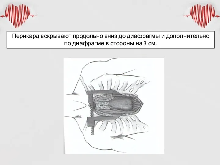 Перикард вскрывают продольно вниз до диафрагмы и дополнительно по диафрагме в стороны на 3 см.