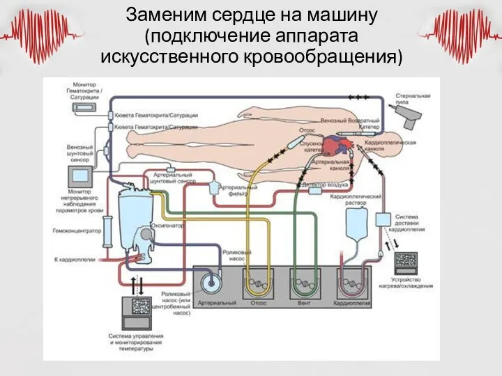 Заменим сердце на машину (подключение аппарата искусственного кровообращения)