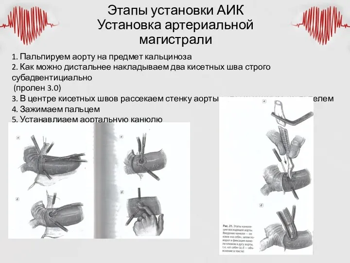 Этапы установки АИК Установка артериальной магистрали 1. Пальпируем аорту на