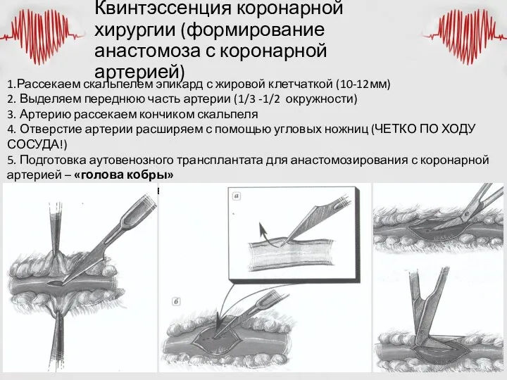 Квинтэссенция коронарной хирургии (формирование анастомоза с коронарной артерией) 1.Рассекаем скальпелем