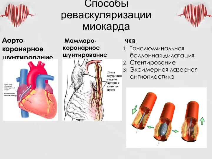 Способы реваскуляризации миокарда Аорто-коронарное шунтирование Маммаро-коронарное шунтирование ЧКВ Танслюминальная баллонная дилатация Стентирование Эксимерная лазерная ангиопластика