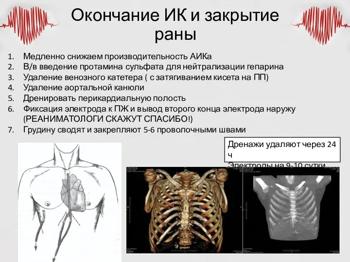 Окончание ИК и закрытие раны Медленно снижаем производительность АИКа В/в