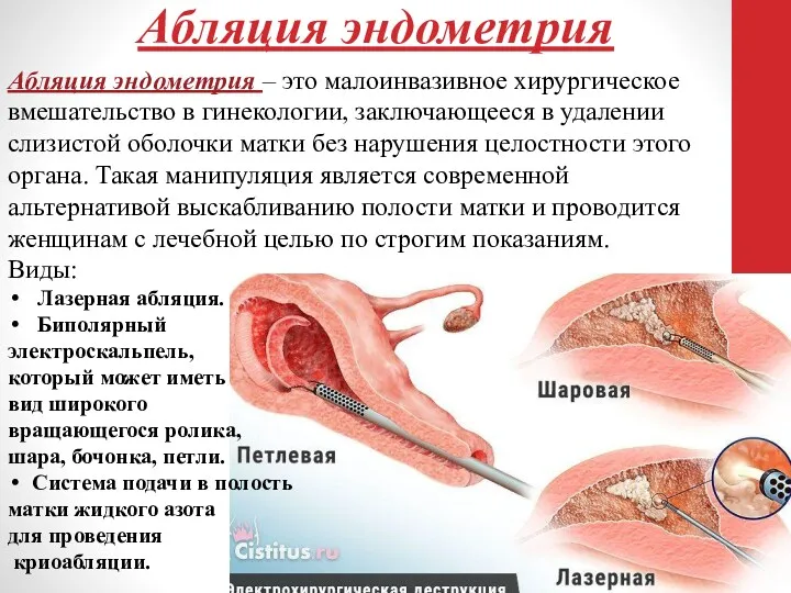 Абляция эндометрия Абляция эндометрия – это малоинвазивное хирургическое вмешательство в