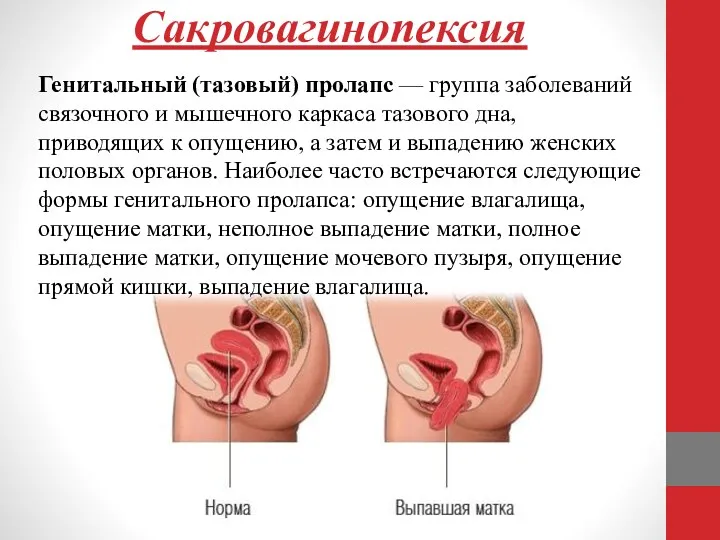 Сакровагинопексия Генитальный (тазовый) пролапс — группа заболеваний связочного и мышечного
