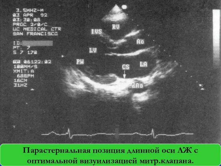 Парастернальная позиция длинной оси ЛЖ с оптимальной визуилизацией митр.клапана.