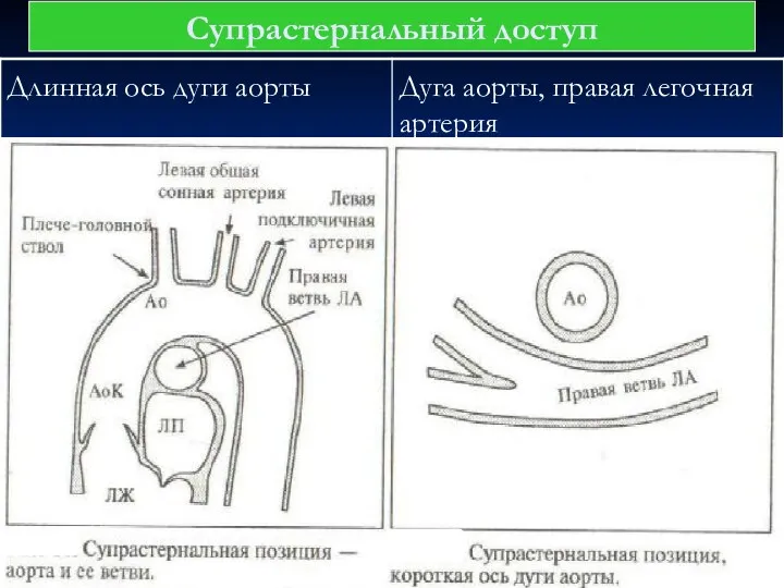 Супрастернальный доступ