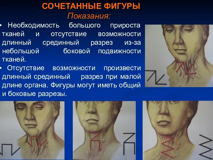 СОЧЕТАННЫЕ ФИГУРЫ Показания: Необходимость большого прироста тканей и отсутствие возможности