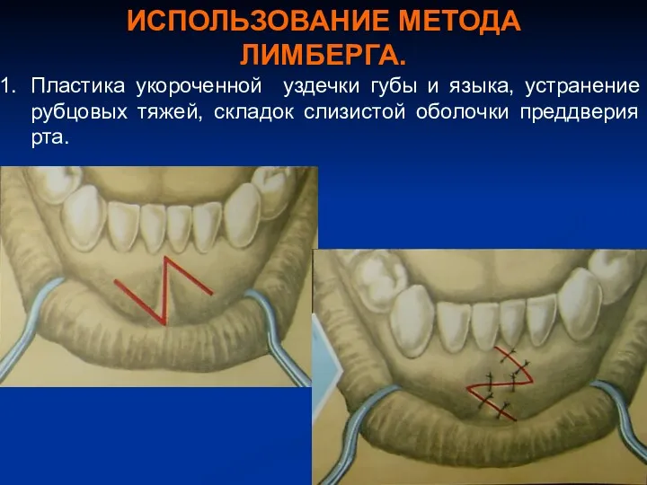ИСПОЛЬЗОВАНИЕ МЕТОДА ЛИМБЕРГА. Пластика укороченной уздечки губы и языка, устранение