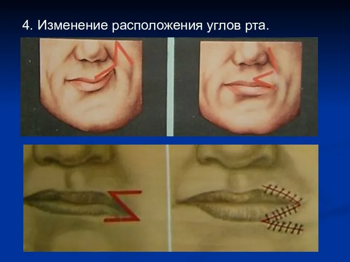 4. Изменение расположения углов рта.