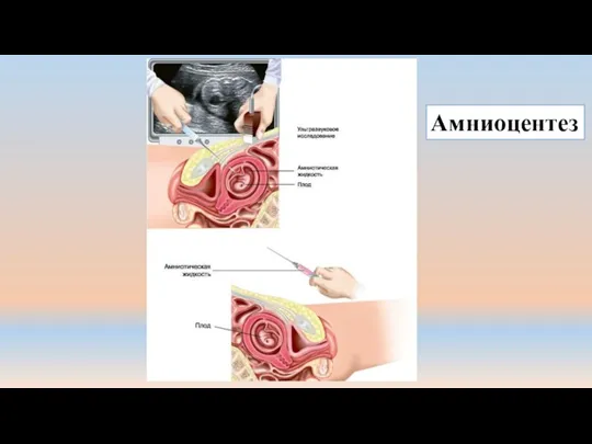 Амниоцентез