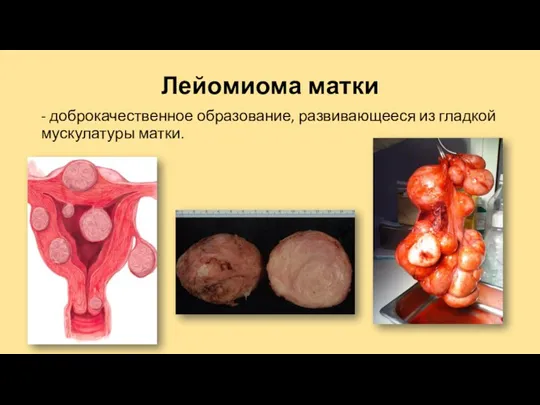 Лейомиома матки - доброкачественное образование, развивающееся из гладкой мускулатуры матки.