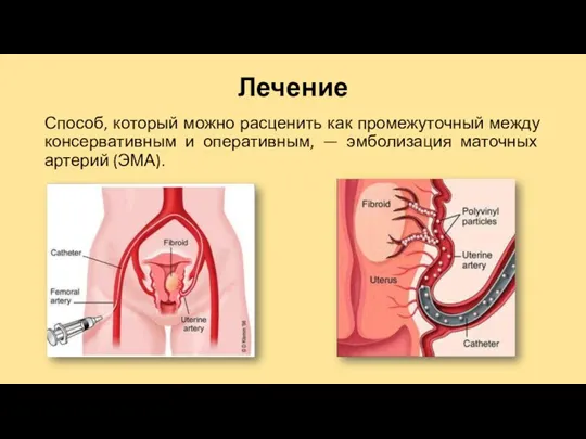 Лечение Способ, который можно расценить как промежуточный между консервативным и оперативным, — эмболизация маточных артерий (ЭМА).