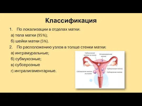 Классификация По локализации в отделах матки: а) тела матки (95%); б) шейки матки