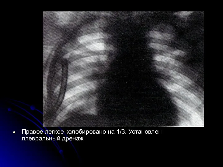 Правое легкое колобировано на 1/3. Установлен плевральный дренаж