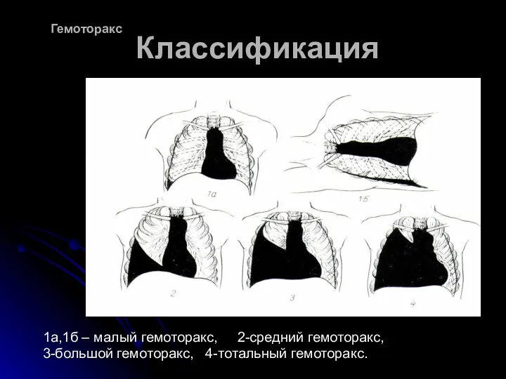 Классификация 1а,1б – малый гемоторакс, 2-средний гемоторакс, 3-большой гемоторакс, 4-тотальный гемоторакс. Гемоторакс