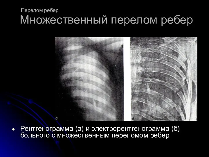 Множественный перелом ребер Рентгенограмма (а) и электрорентгенограмма (б) больного с множественным переломом ребер Перелом ребер